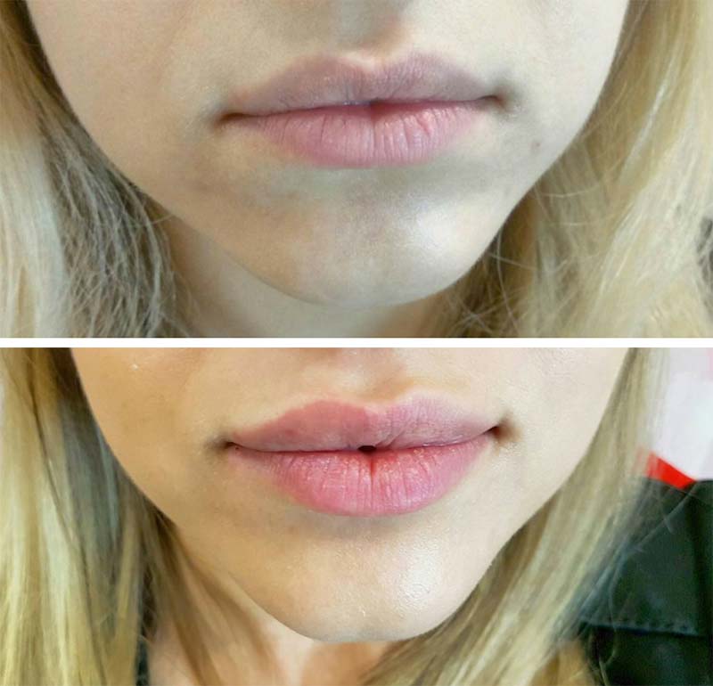 Lip Fillers Guide: What Are Lip Fillers?