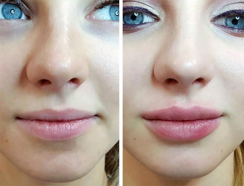 Lip Fillers Types, Costs, Side Effects