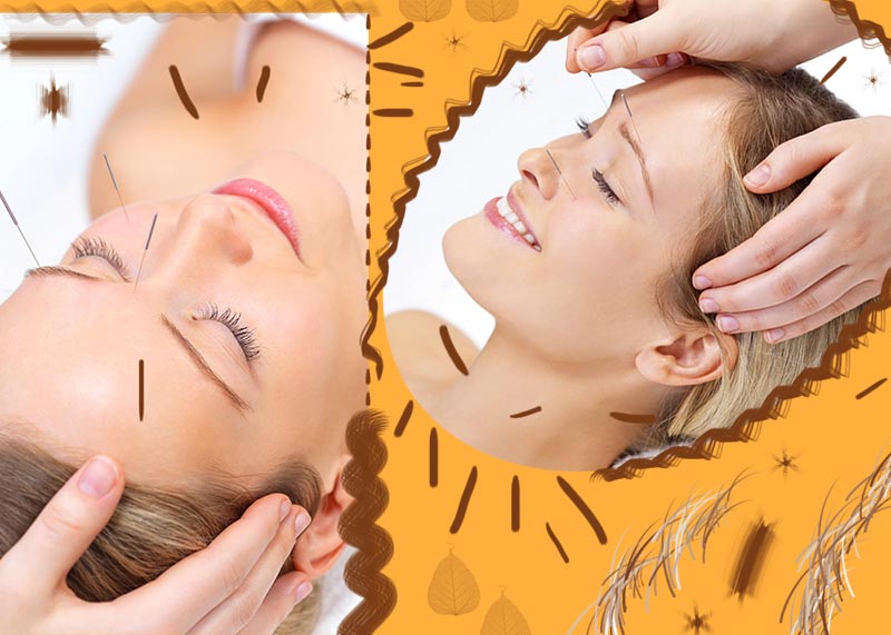 What Is Cosmetic Acupuncture? Facial Acupuncture Benefits, Costs