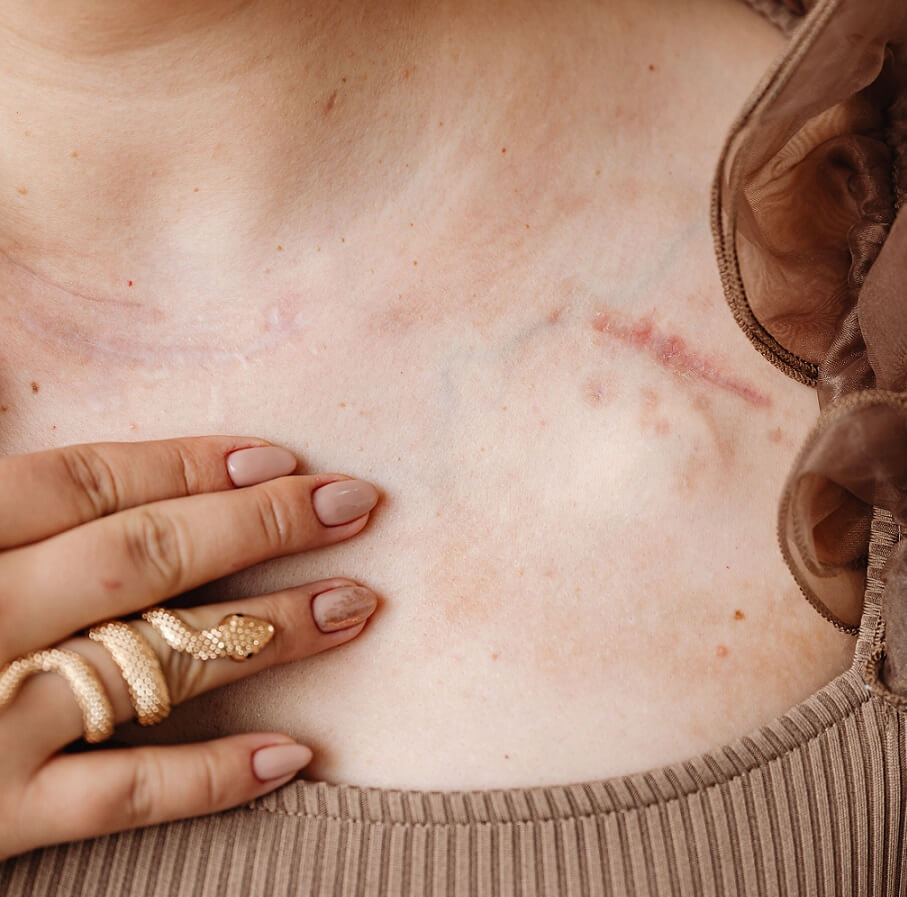 Scar on woman's collar bone
