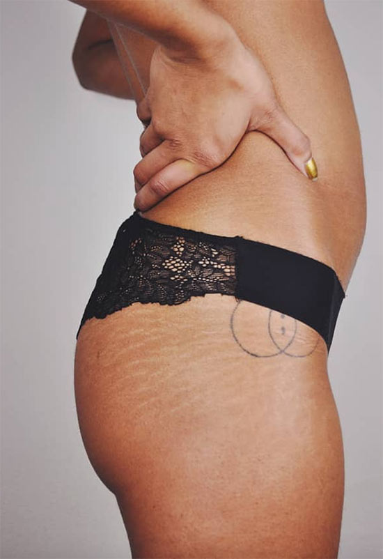 What Are Stretch Marks? Causes of Stretch Marks
