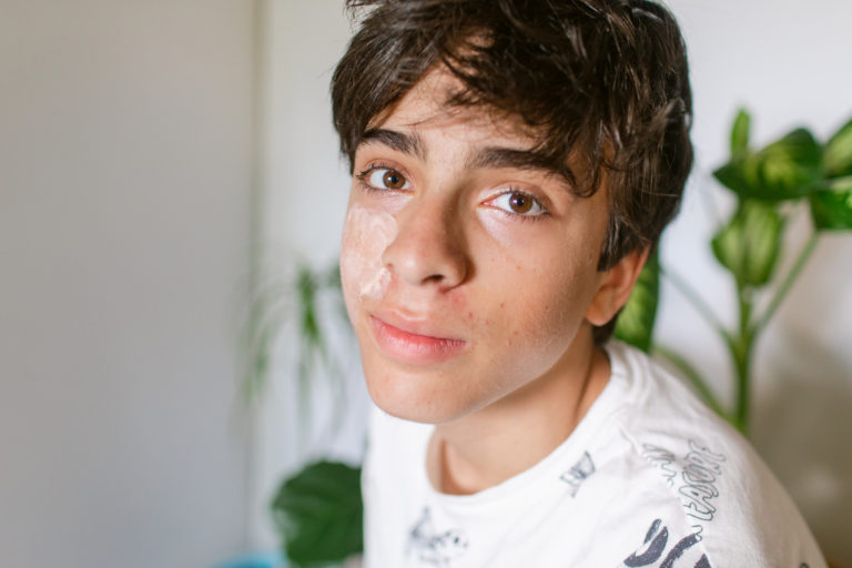 teenage boy with acne treatment
