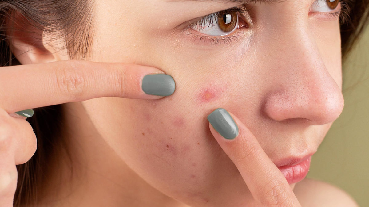 Acne scarring featured image