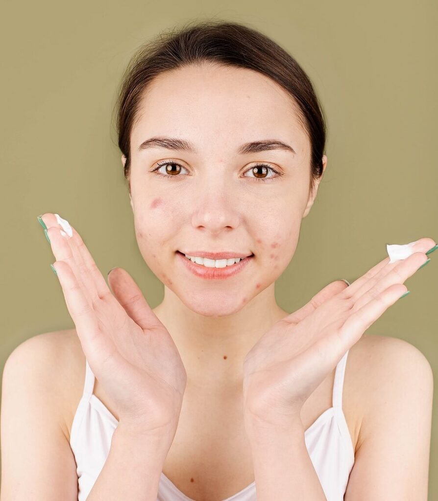 Woman with pimples about to put facial cream on