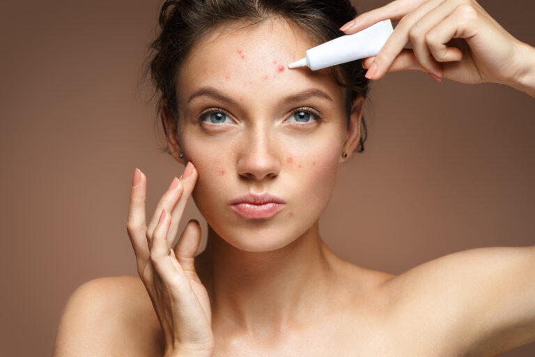 acne-treatment-woman
