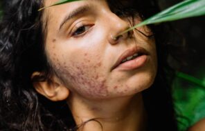 Best Acne Scar Treatments of 2023