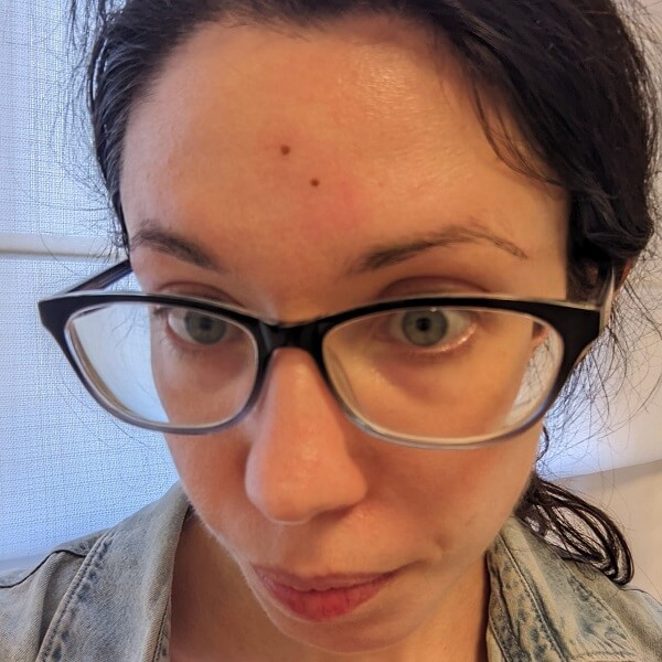 Immediately after electrocautery on the forehead